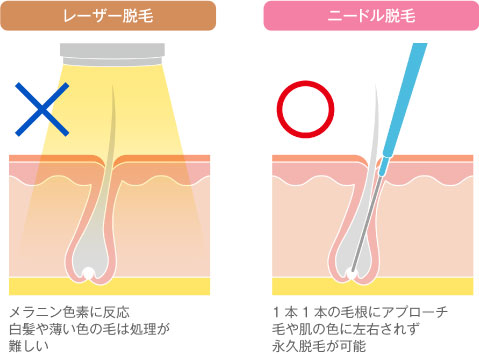 レーザー脱毛とニードル脱毛の施術方法の図解